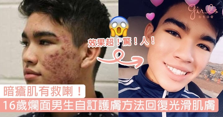 暗瘡肌有救喇！16歲「爛面」外國男生自訂護膚方法，8個月後回復光滑肌膚，網民：效果實在驚為天人！