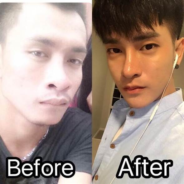 泰國男仔3年做30次整容手術