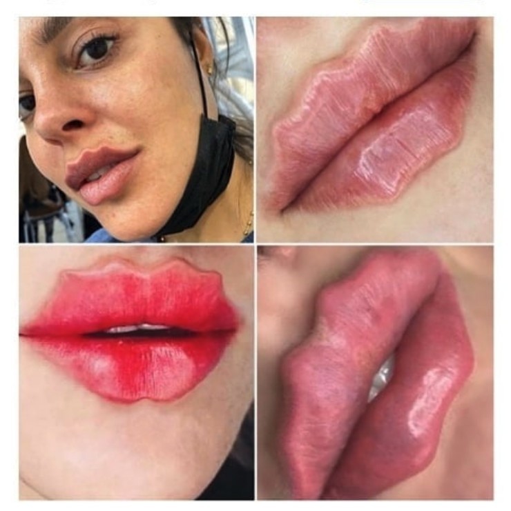 「魔鬼唇形」Devil Lips是由俄羅斯整型醫生Emelian Braude 創立