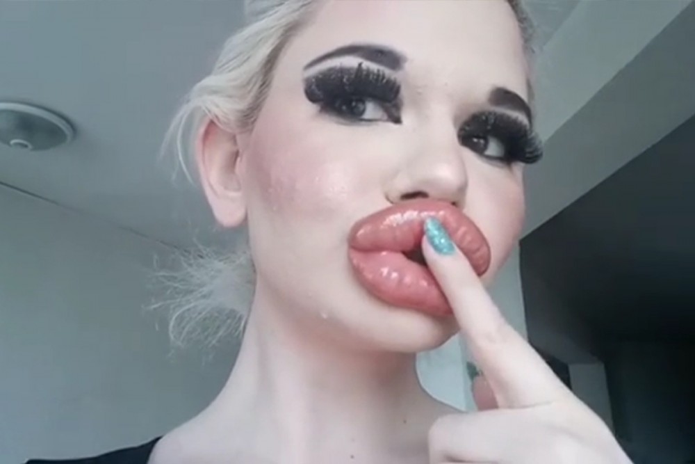 整容世界最厚唇 22歲少女Andrea Ivanova