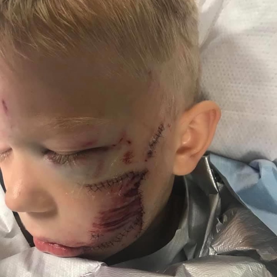 6歲哥哥Bridger勇救被狗襲擊妹妹,受傷縫近90針!Chris Evans親自讚揚是英雄
