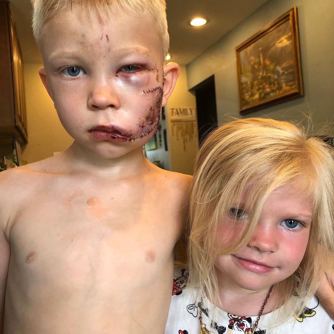 6歲哥哥Bridger勇救被狗襲擊妹妹,受傷縫近90針!Chris Evans親自讚揚是英雄