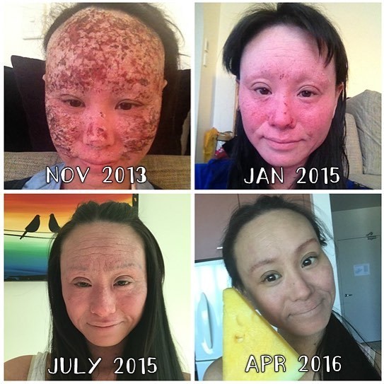 濕疹, 濕疹根治, 濕疹戒類固醇, 類固醇濕疹, 濕疹斷尾