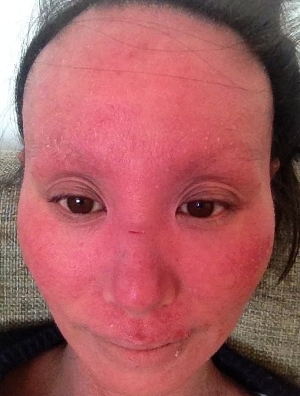 濕疹, 濕疹根治, 濕疹戒類固醇, 類固醇濕疹, 濕疹斷尾