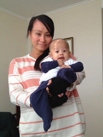 濕疹, 濕疹根治, 濕疹戒類固醇, 類固醇濕疹, 濕疹斷尾