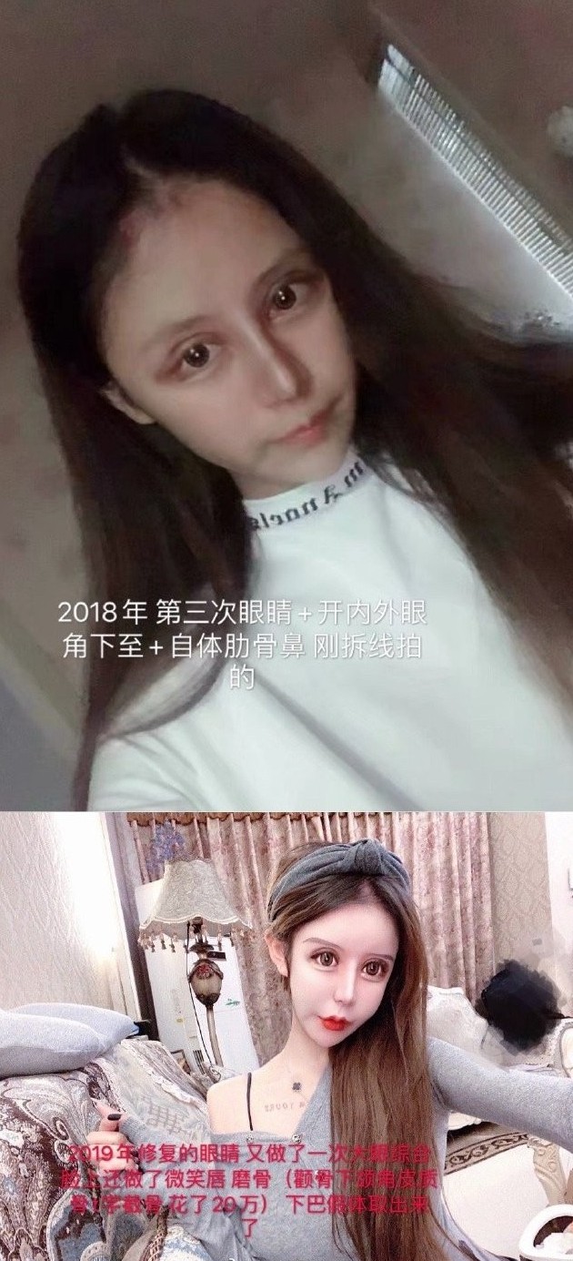 整容上癮, 整容失敗, 整容, 玻尿酸, 大陸網紅, 蛇精女,