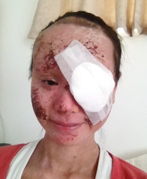 濕疹, 濕疹根治, 濕疹戒類固醇, 類固醇濕疹, 濕疹斷尾