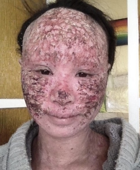 濕疹, 濕疹根治, 濕疹戒類固醇, 類固醇濕疹, 濕疹斷尾