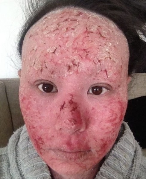 濕疹, 濕疹根治, 濕疹戒類固醇, 類固醇濕疹, 濕疹斷尾