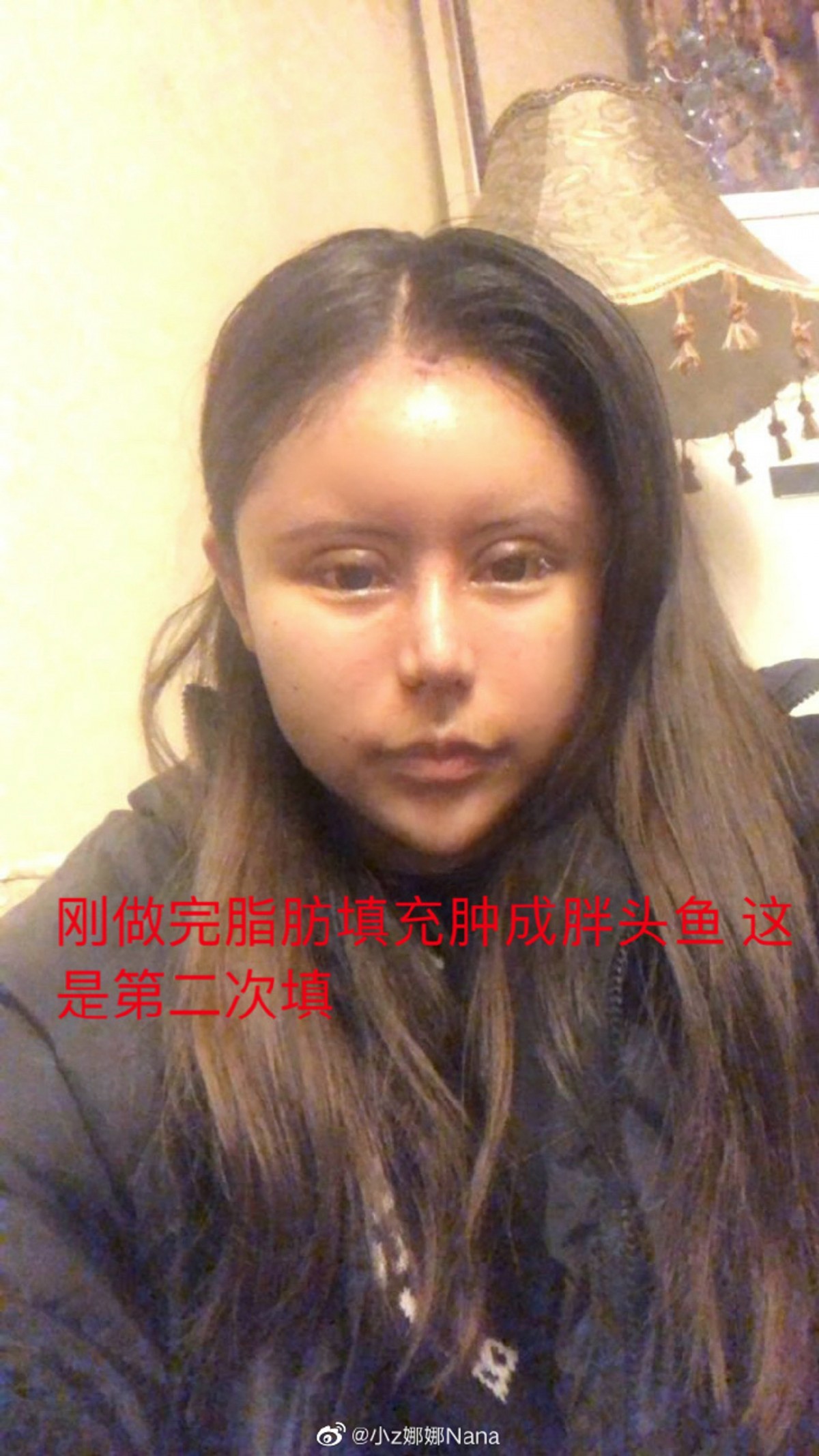 整容上癮, 整容失敗, 整容, 玻尿酸, 大陸網紅, 蛇精女,
