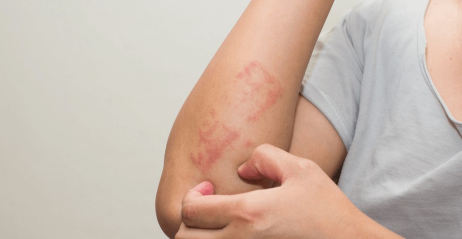 濕疹, 濕疹根治, 濕疹戒類固醇, 類固醇濕疹, 濕疹斷尾