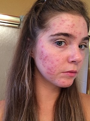 Nina與Randa也用盡了多種方法去解決滿臉暗瘡的問題,包括改變不同的潔面產品、曾試過服用超過一年的抗生素