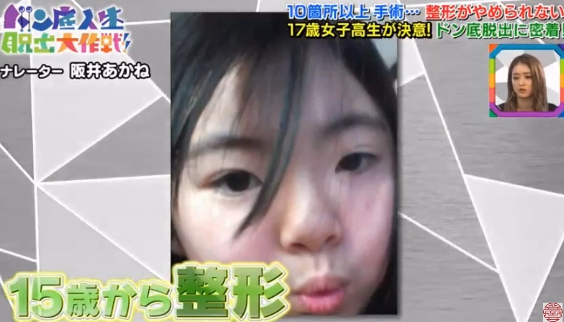 日本女生,整容成癮,整容,整容前後