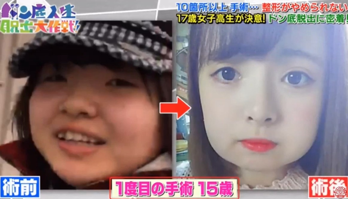 日本女生,整容成癮,整容,整容前後