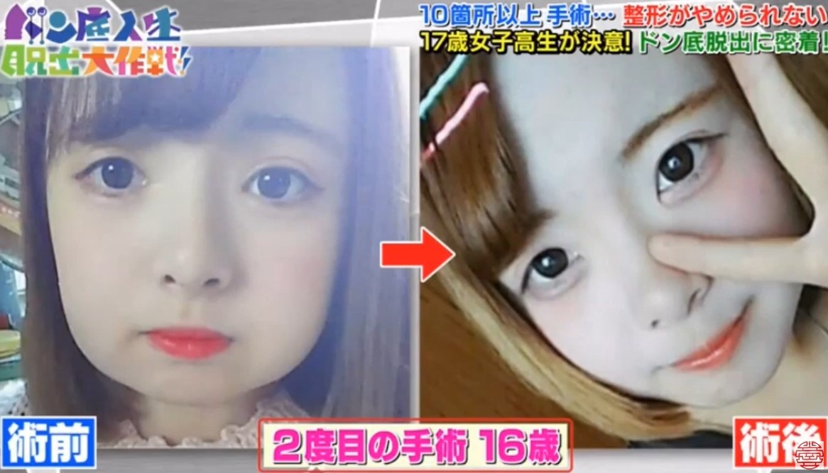 日本女生,整容成癮,整容,整容前後