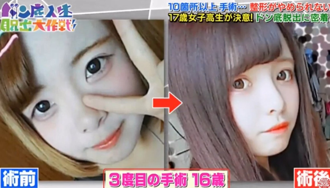日本女生,整容成癮,整容,整容前後