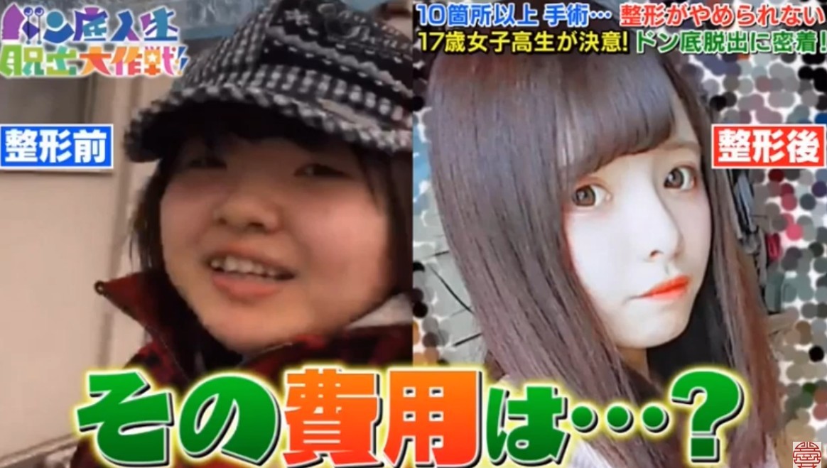 日本女生,整容成癮,整容,整容前後