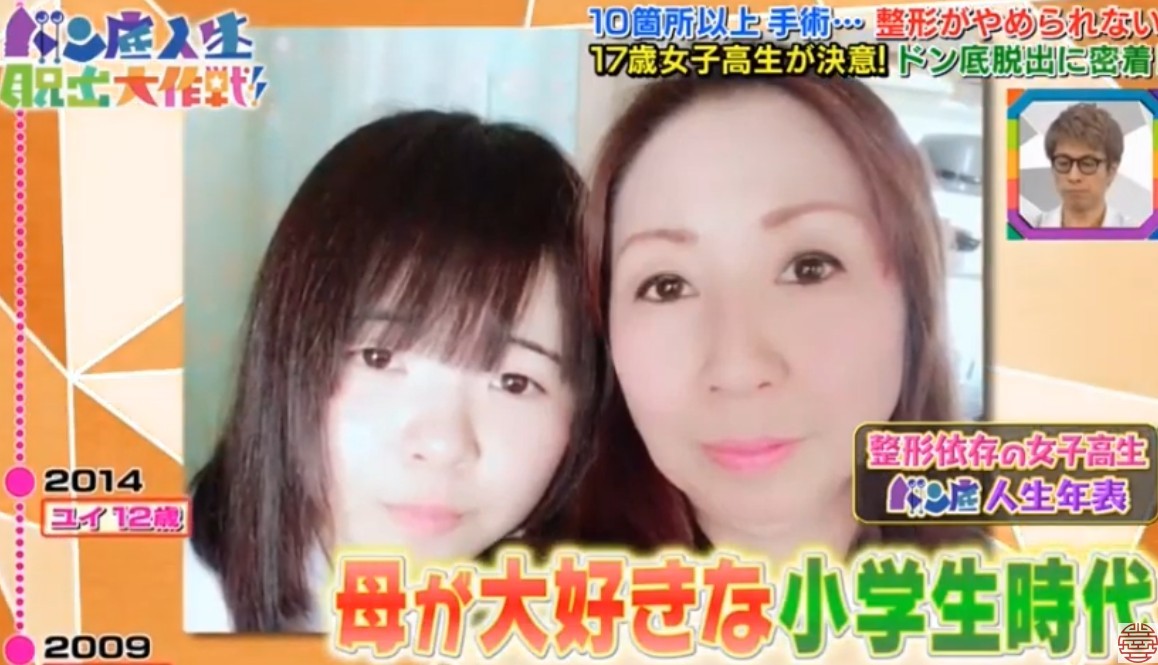 日本女生,整容成癮,整容,整容前後