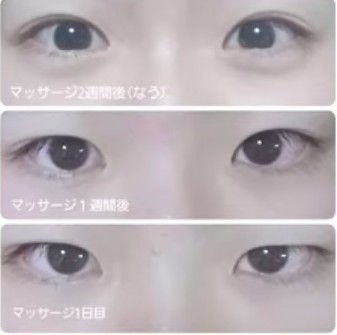 日本大熱,整容級,眼部按摩,放大眼睛,水腫眼,雙眼皮,臥蠶