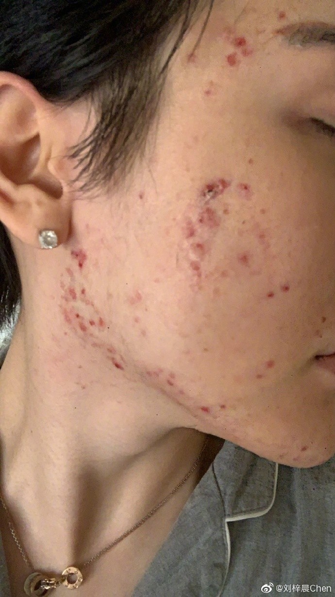 內地「蛇精男」劉梓晨消失3個月自爆全臉毀容!崩潰發文:不知道如何面對我的臉和生活!