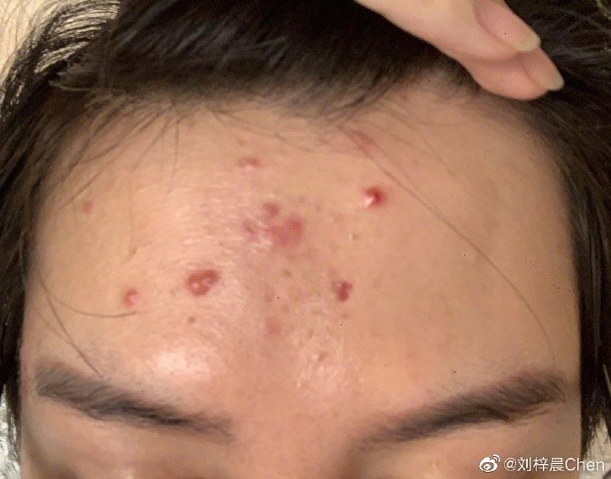 內地「蛇精男」劉梓晨消失3個月自爆全臉毀容!崩潰發文:不知道如何面對我的臉和生活!