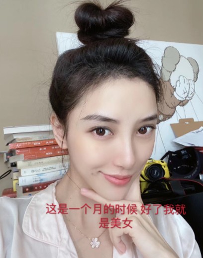 髮際線, 髮線後移, 髮線高, 闊額頭, 再生髮際線, 植髮