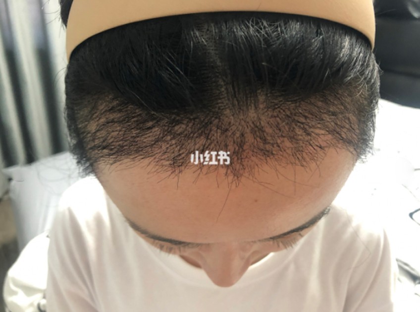 髮際線, 髮線後移, 髮線高, 闊額頭, 再生髮際線, 植髮