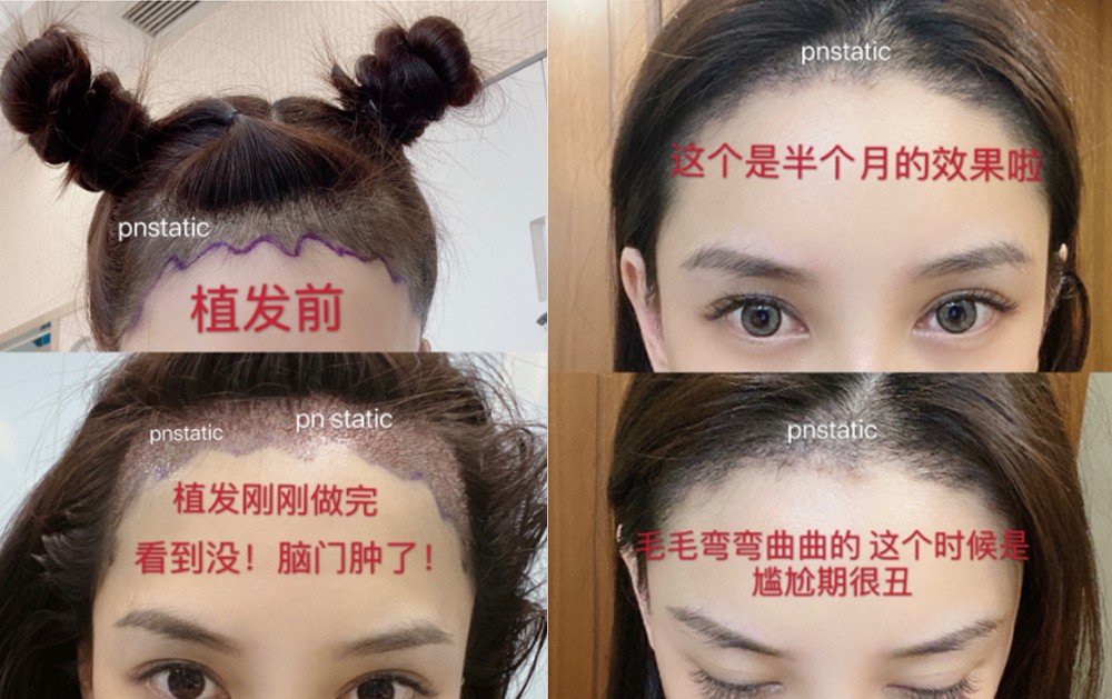 髮際線, 髮線後移, 髮線高, 闊額頭, 再生髮際線, 植髮