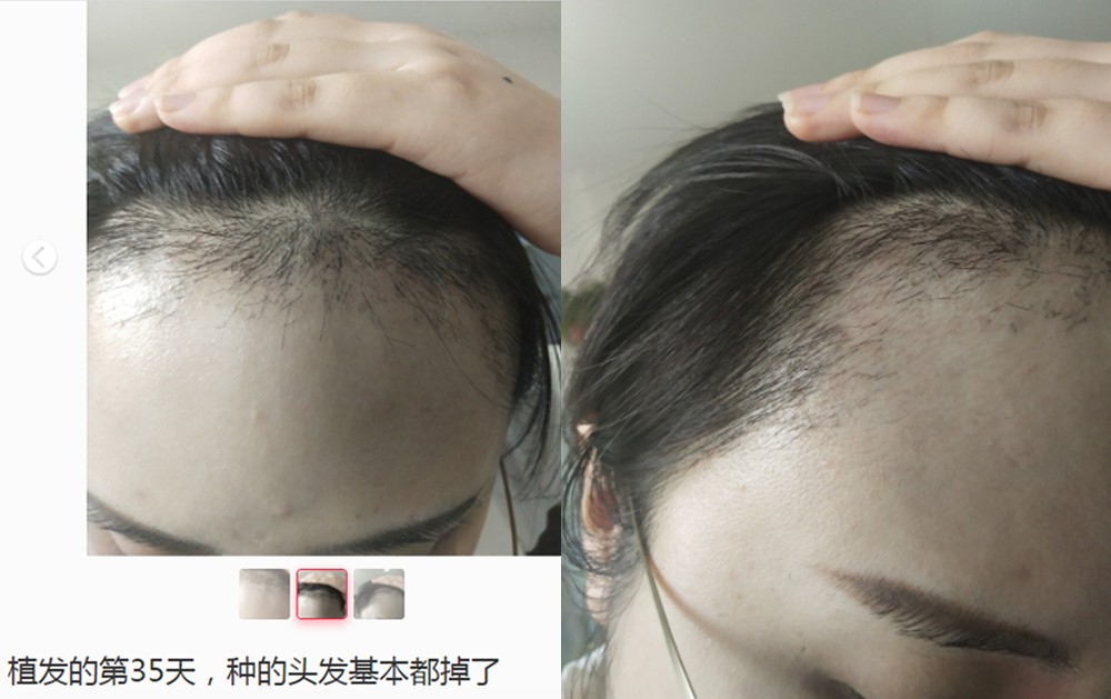 髮際線, 髮線後移, 髮線高, 闊額頭, 再生髮際線, 植髮