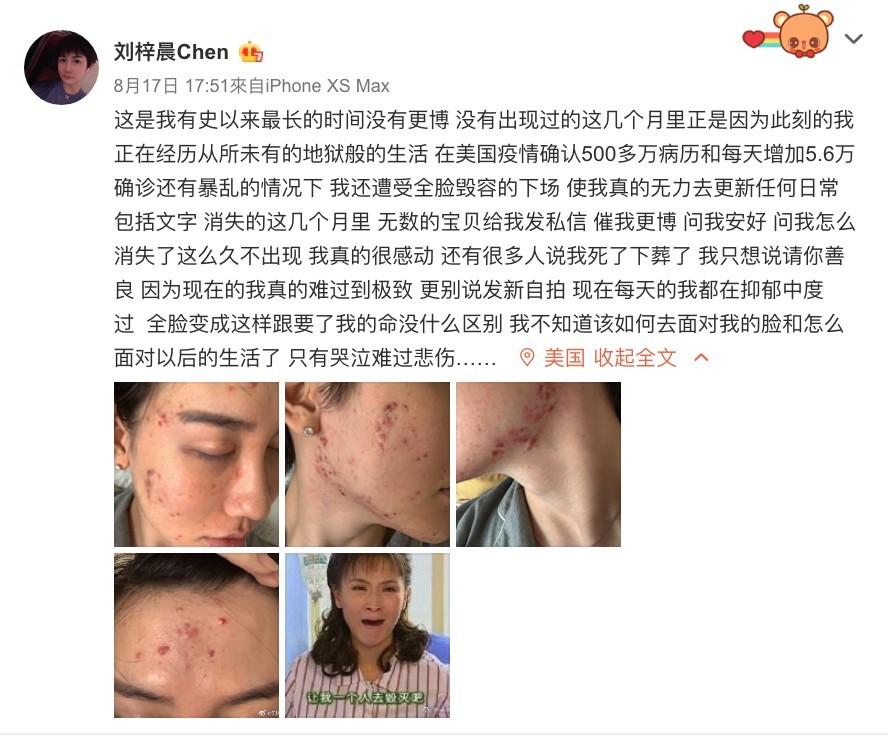 內地「蛇精男」劉梓晨消失3個月自爆全臉毀容!崩潰發文:不知道如何面對我的臉和生活!