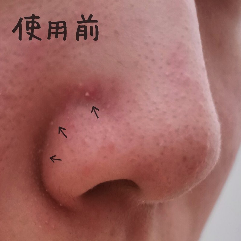 日本大賣,回購不斷,Daiso好物,去黑頭,收毛孔