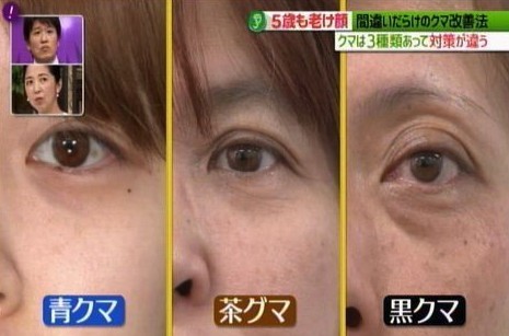 黑眼圈顏色,去黑眼圈,黑眼圈形成,日本醫生
