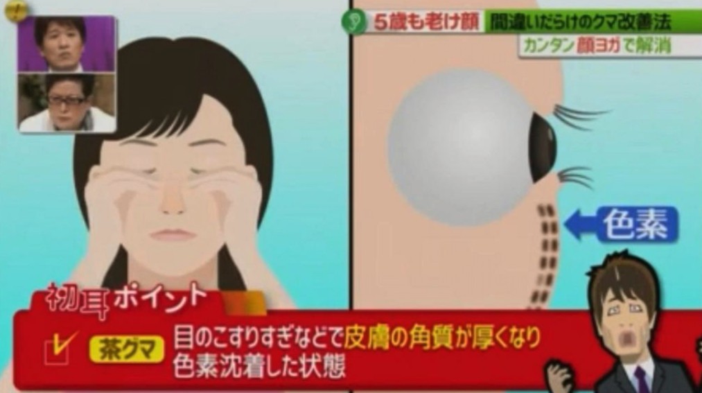 黑眼圈顏色,去黑眼圈,黑眼圈形成,日本醫生
