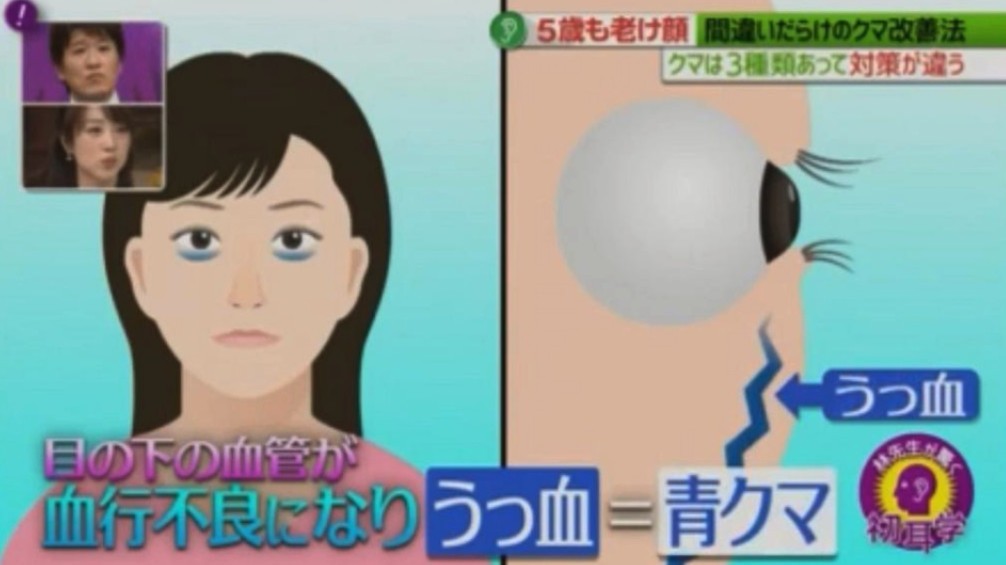 黑眼圈顏色,去黑眼圈,黑眼圈形成,日本醫生