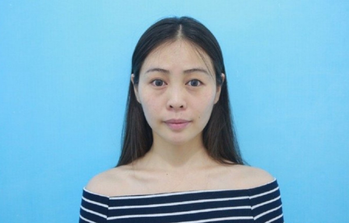 內地女生微博分享整容Before&After!隆鼻縮鼻翼/削骨/雙眼皮效果超驚人