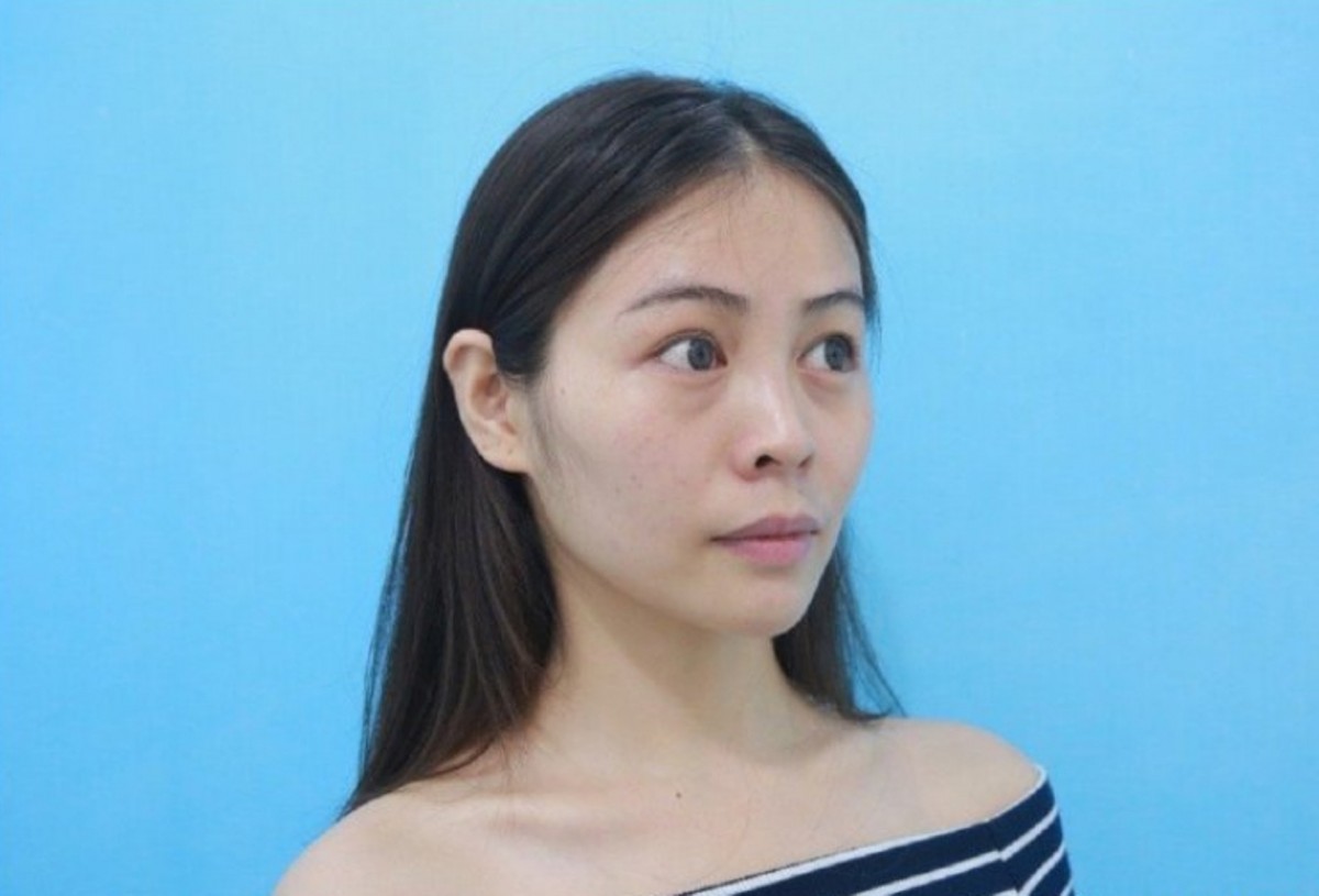 內地女生微博分享整容Before&After!隆鼻縮鼻翼/削骨/雙眼皮效果超驚人
