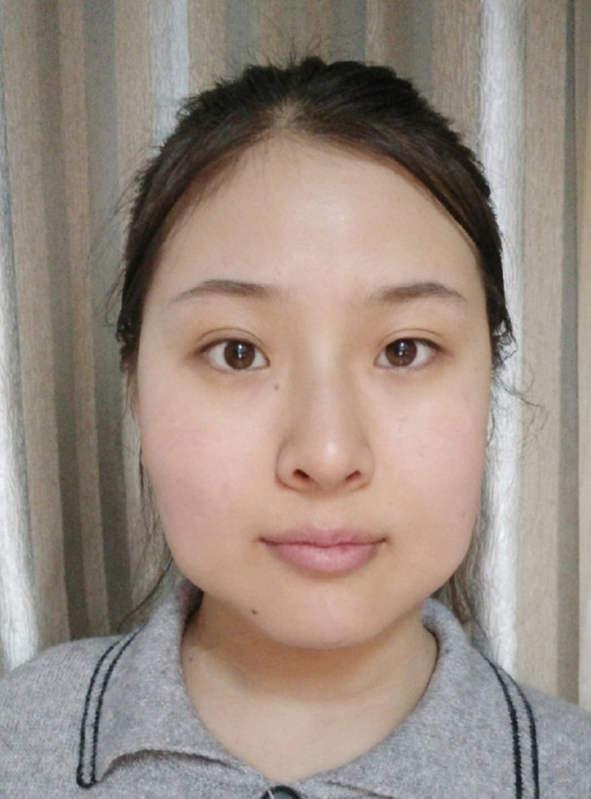 內地女生微博分享整容Before&After!隆鼻縮鼻翼/削骨/雙眼皮效果超驚人