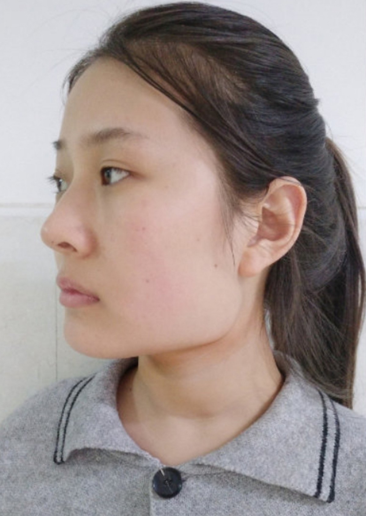 內地女生微博分享整容Before&After!隆鼻縮鼻翼/削骨/雙眼皮效果超驚人