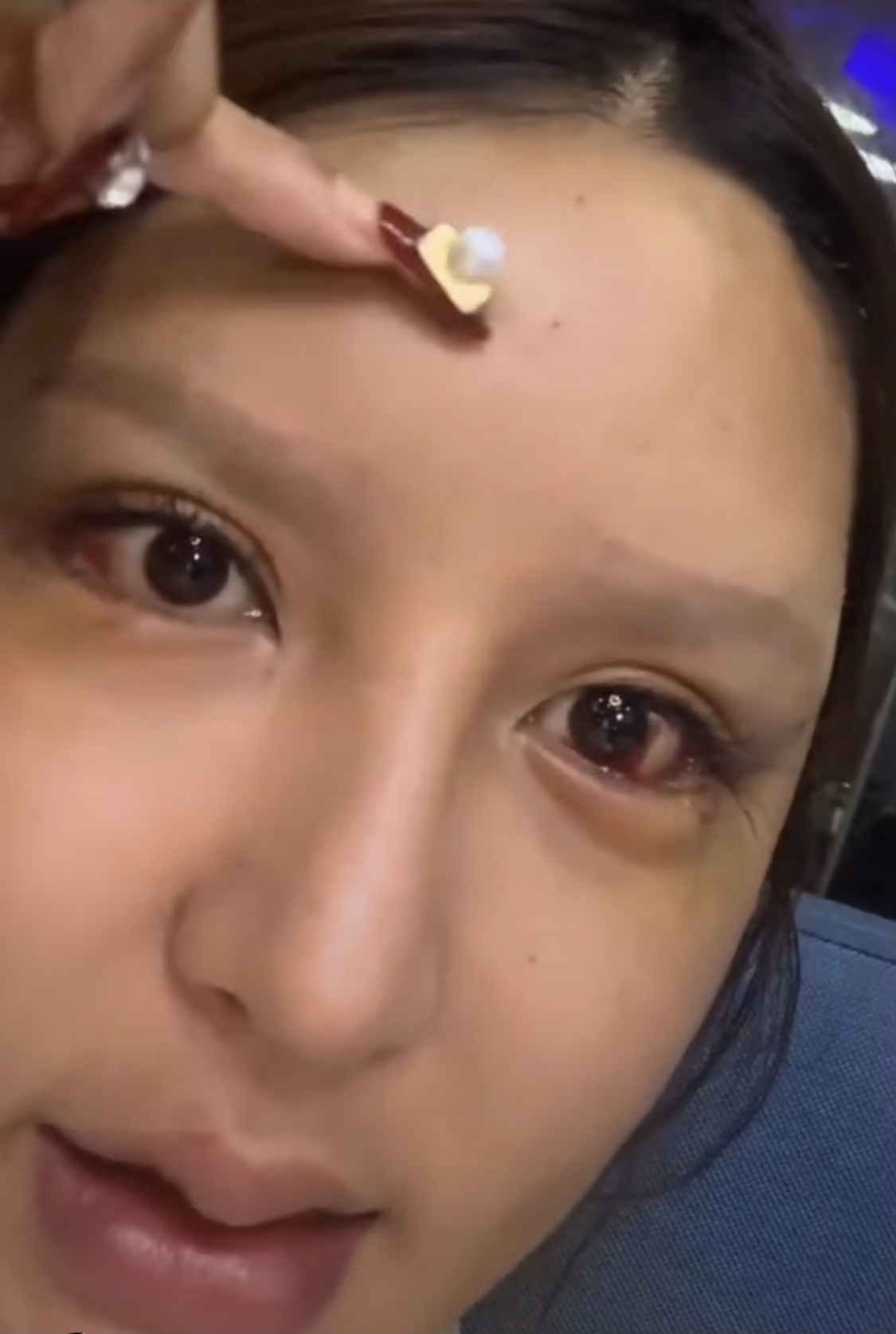 桃花寶寶19他的眼睛已經整過無數次,包括開眼頭、開眼尾、韓式臥蠶和割雙眼皮。不少部分也有整失敗過,他曾經整到眼眶通紅,紅腫得兩邊得臥蠶也不對稱。另一次甚至弄得眼球出血。