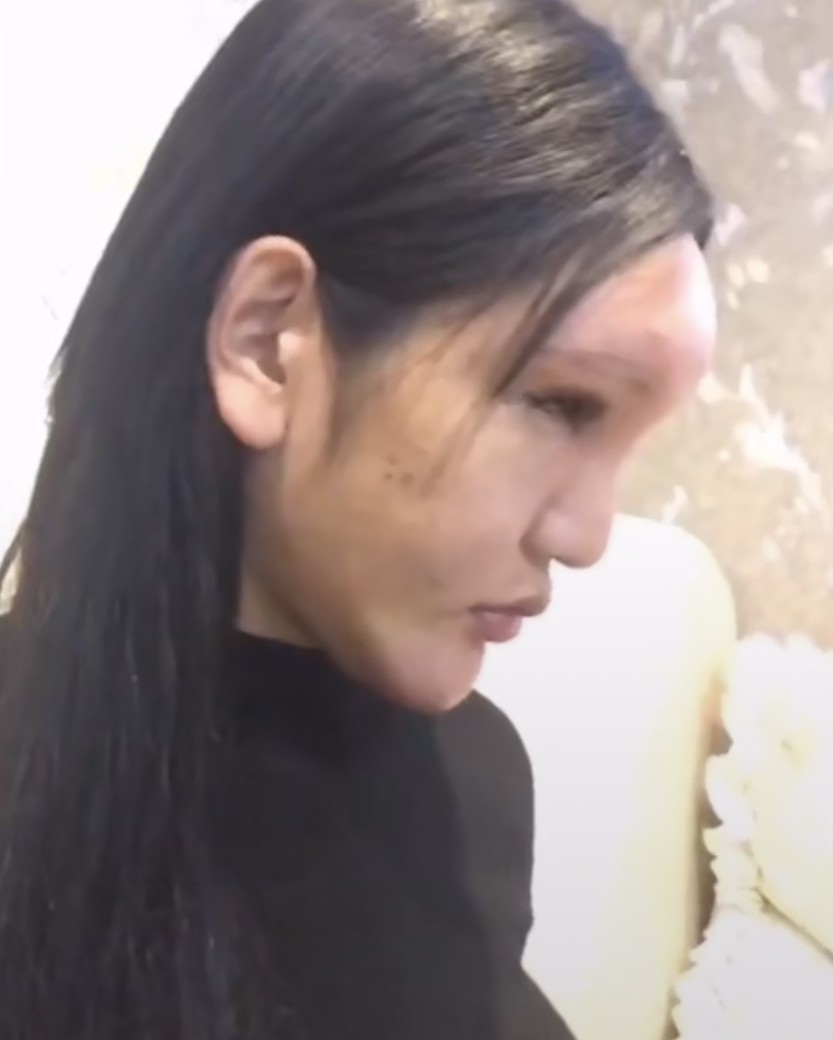 桃花寶寶31近年他身體漸漸開始出現各類型的整容後遺症,除了眼睛抽搐之外,額頭也腫得很不自然,突出一塊奇怪的東西,臉部和眼睛也開始下墜。