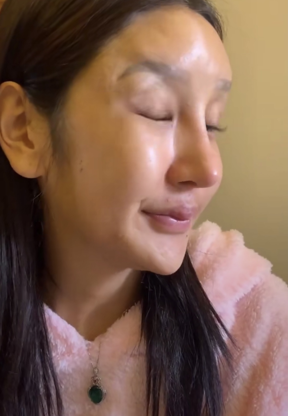 桃花寶寶37臉部的整形更是不少,包括美白針、瘦臉針玻尿酸、和豐下巴和蘋果肌。但是近年的玻尿酸也開始溶解,溶解後在裏面亂流,結果流到眼睛的部分,更壓到神經線,導致眼睛出現超大的健康問題。
