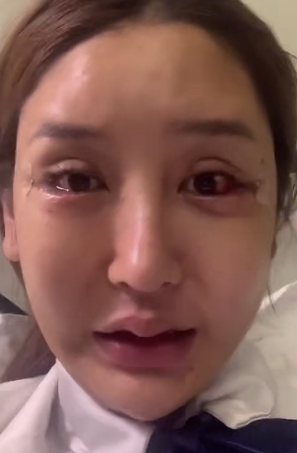 桃花寶寶9他的眼睛已經整過無數次,包括開眼頭、開眼尾、韓式臥蠶和割雙眼皮。不少部分也有整失敗過,他曾經整到眼眶通紅,紅腫得兩邊得臥蠶也不對稱。另一次甚至弄得眼球出血。