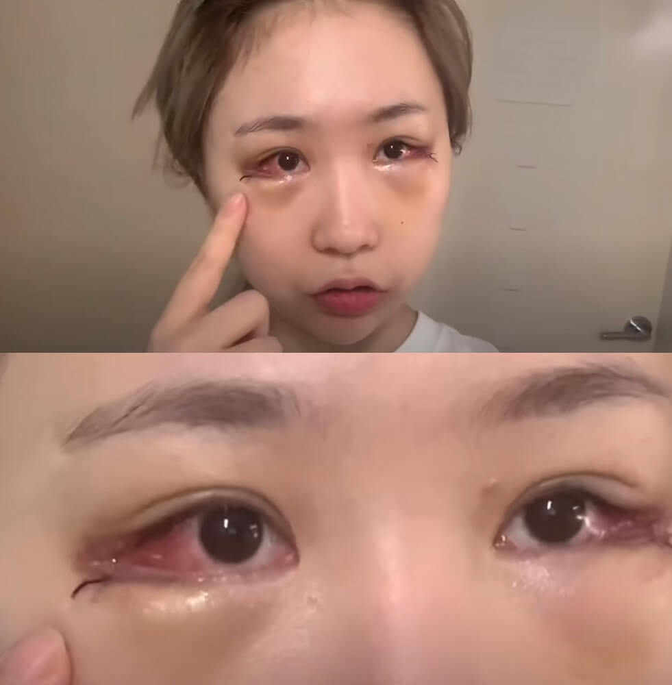 趙秀珍做臥蠶手術、開眼角的影片,更有超過過百萬的點撃率!