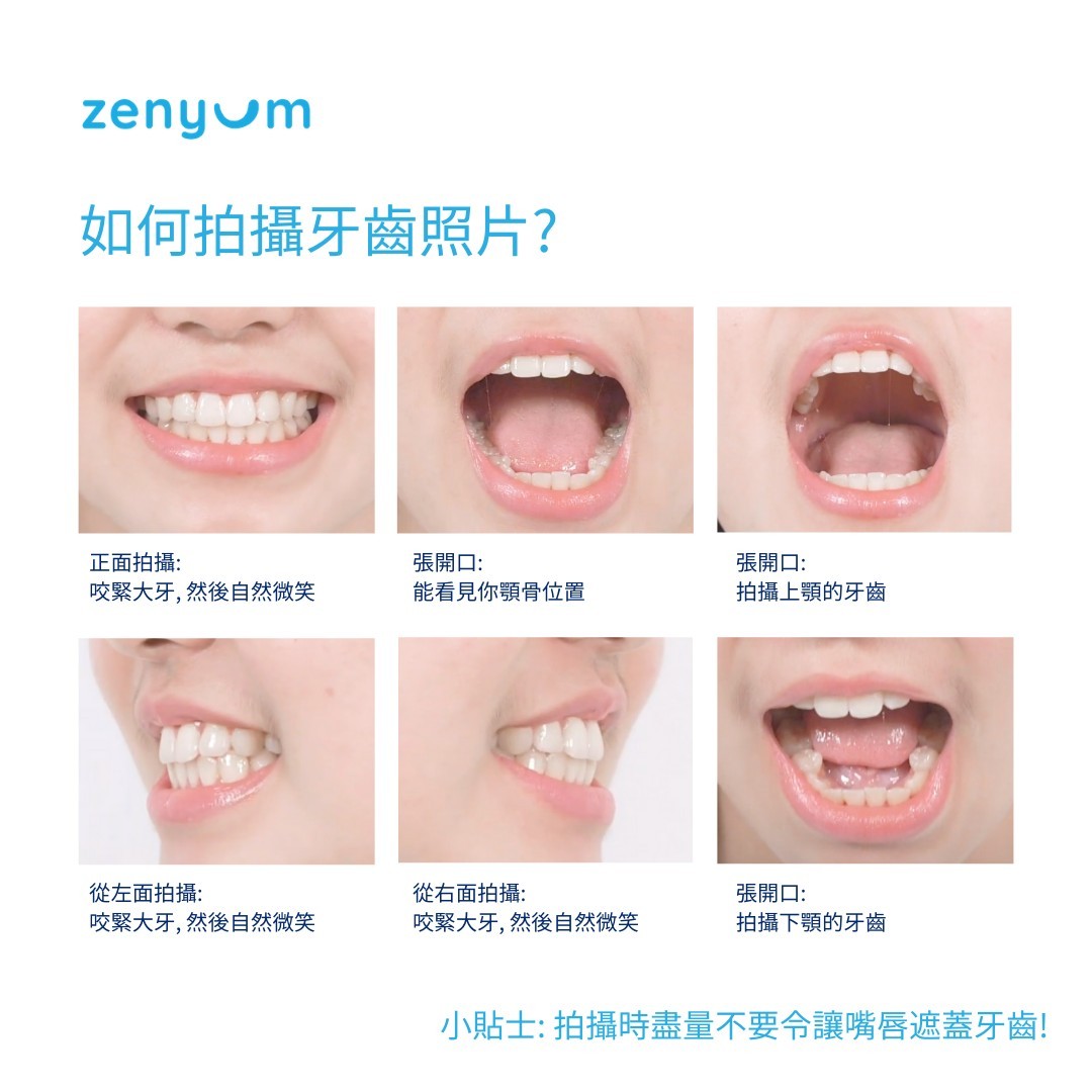 先拍下你的牙齒照片並上戴到其官網登記。當Zenyum專業的牙醫團隊爲你初步評估後,若覺得你合適使用Zenyum,你便需要到香港註冊牙醫診所進行詳細諮詢。