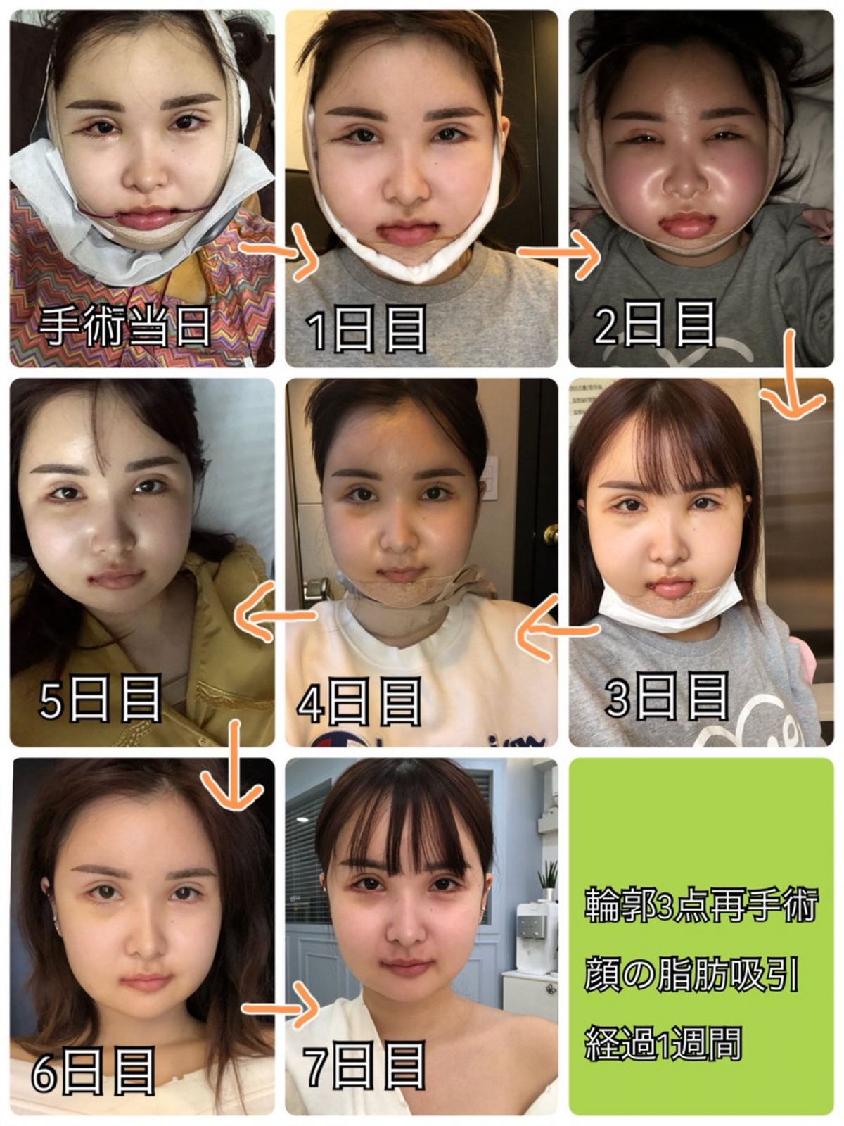 【整容後遺症】最後手術也成功了,同時也瘦了8公斤。家人了解她的狀況後,也每天發短訊關心和支持她,更貼心照顧她起居飲食,為她烹調流質食物