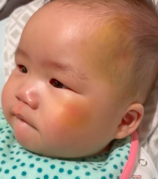 她近日接受東張西望訪問,描述當時情況驚險,賊人加害家中外傭及其六個月大的兒子,令他們身上有瘀傷。
