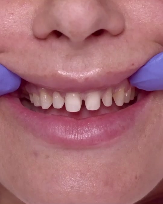 近日的抖音上就出現了一個＂Shark Teeth＂（鯊魚牙齒）新熱潮