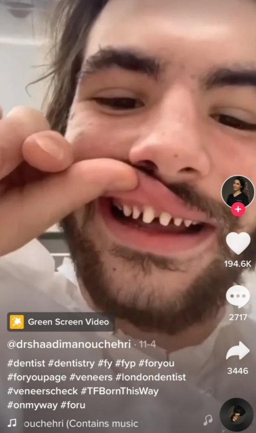 近日的抖音上就出現了一個＂Shark Teeth＂（鯊魚牙齒）新熱潮，