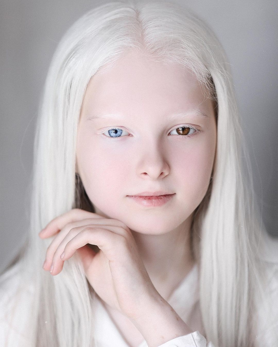 阿尔比诺 白化症综合征的可爱小女孩 库存照片. 图片 包括有 敬慕, 逗人喜爱, 人力, 头发, 正餐 - 184861214