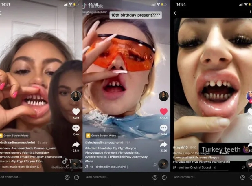 近日的抖音上就出現了一個＂Shark Teeth＂（鯊魚牙齒）新熱潮，